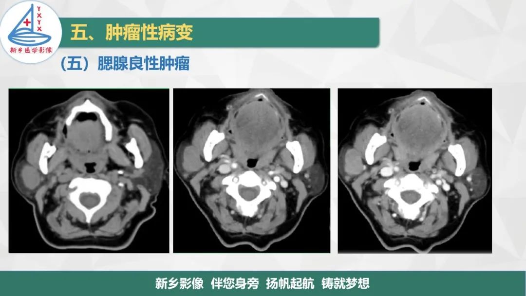 影像PPT - 【PPT】医学影像诊断学教材解读—口腔颌面部疾病2-18