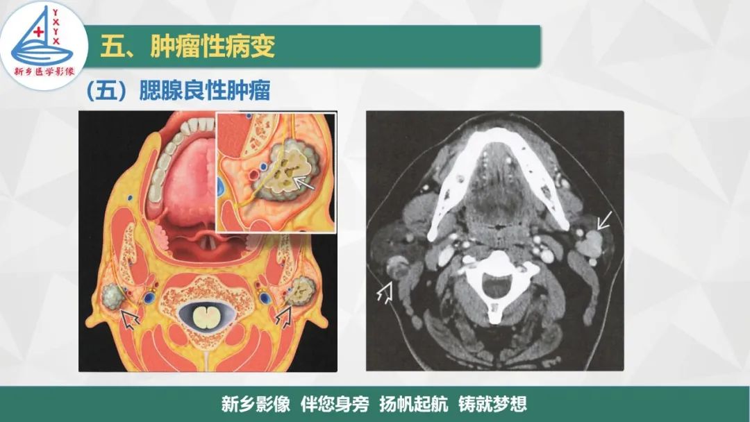 影像PPT - 【PPT】医学影像诊断学教材解读—口腔颌面部疾病2-19