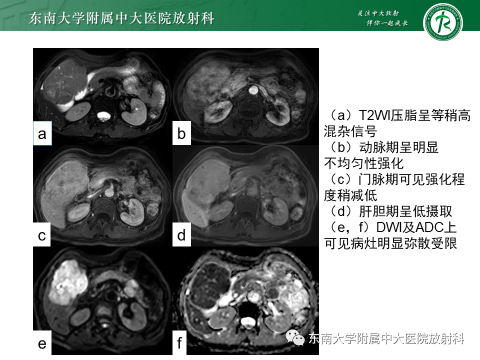 影像PPT - 【PPT】肝细胞癌（HCC）的影像-4