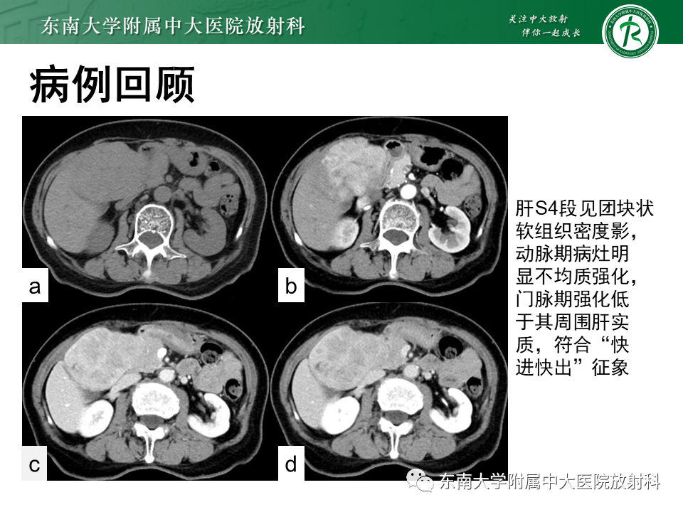 影像PPT - 【PPT】肝细胞癌（HCC）的影像-3