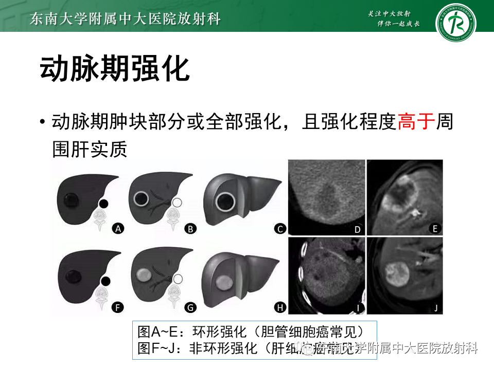 影像PPT - 【PPT】肝细胞癌（HCC）的影像-15