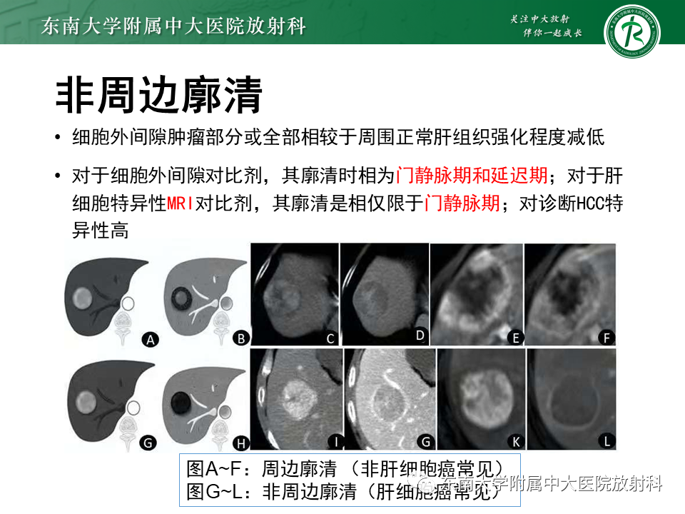 影像PPT - 【PPT】肝细胞癌（HCC）的影像-16