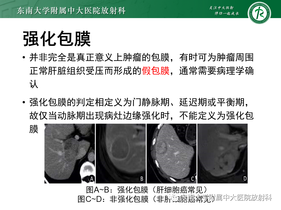 影像PPT - 【PPT】肝细胞癌（HCC）的影像-17