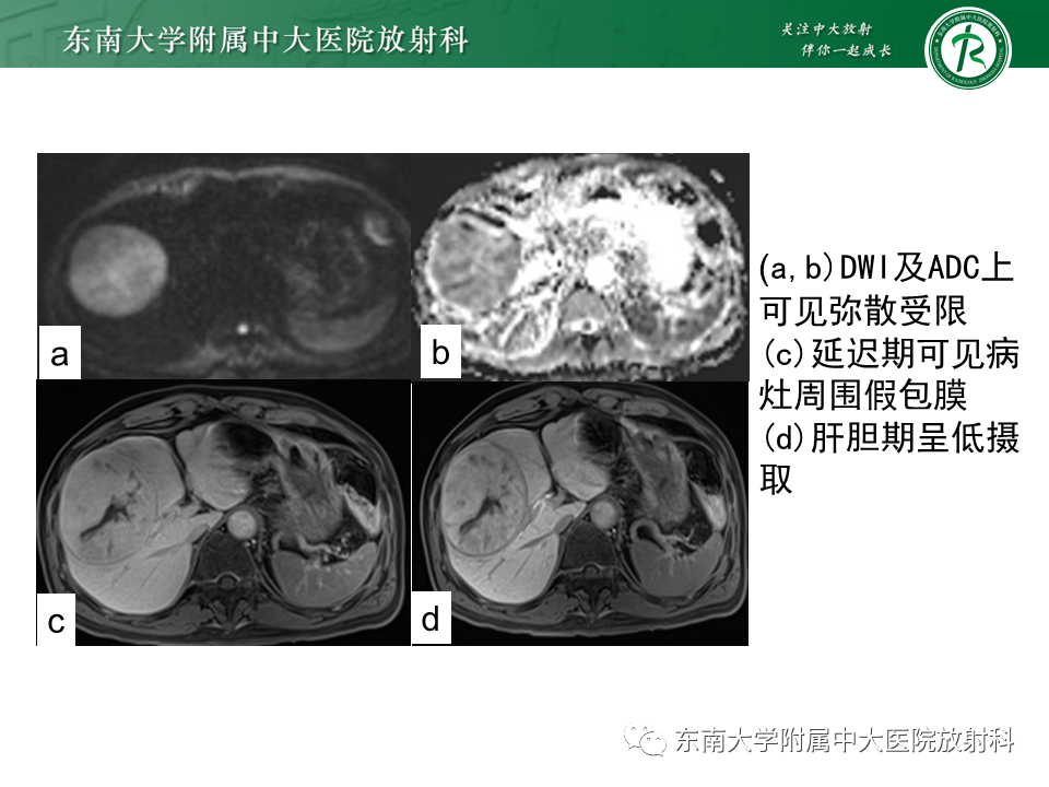 影像PPT - 【PPT】肝细胞癌（HCC）的影像-21