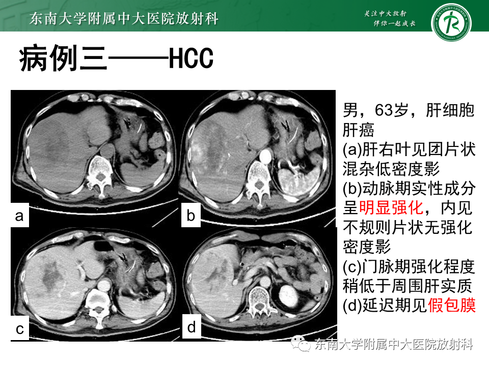 影像PPT - 【PPT】肝细胞癌（HCC）的影像-20