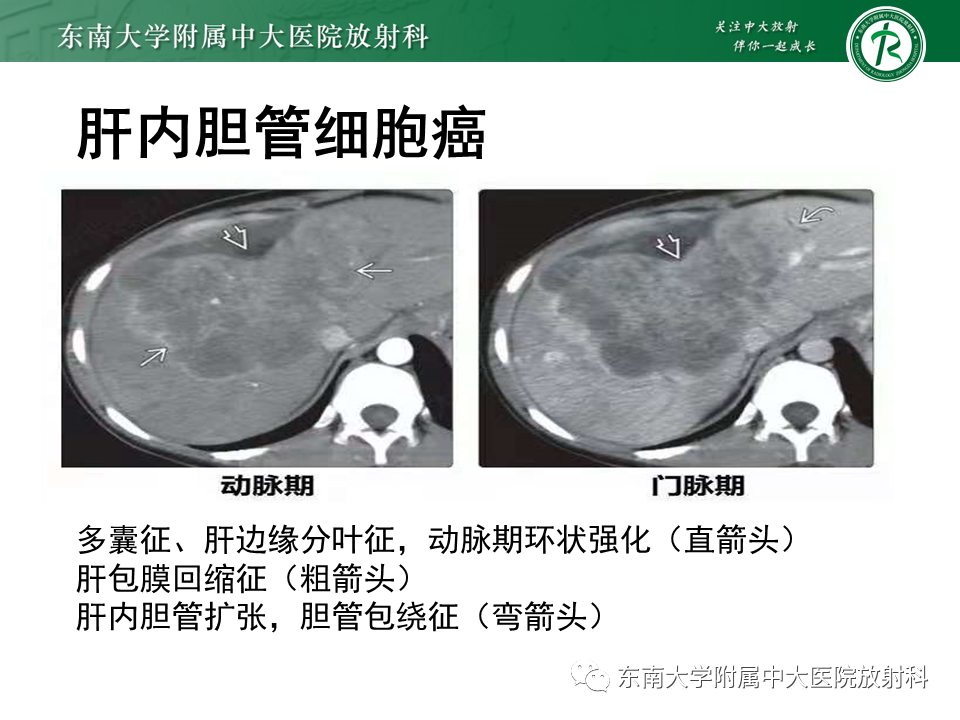 影像PPT - 【PPT】肝细胞癌（HCC）的影像-24