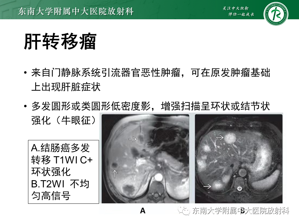 影像PPT - 【PPT】肝细胞癌（HCC）的影像-25