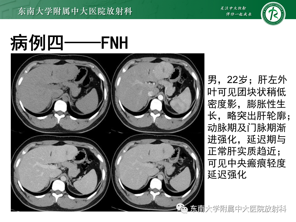 影像PPT - 【PPT】肝细胞癌（HCC）的影像-28