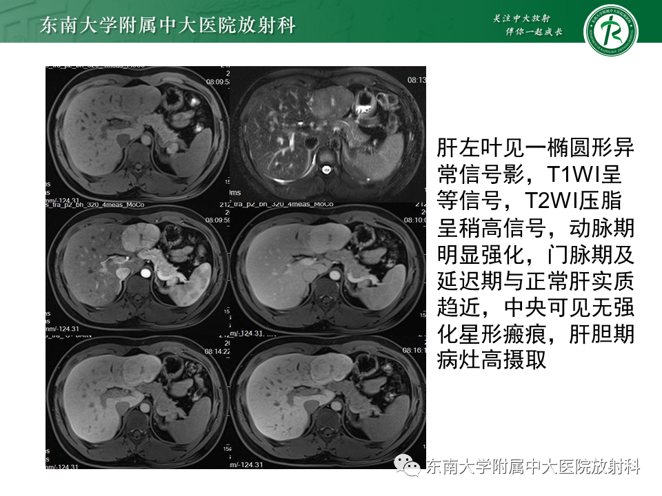 影像PPT - 【PPT】肝细胞癌（HCC）的影像-29