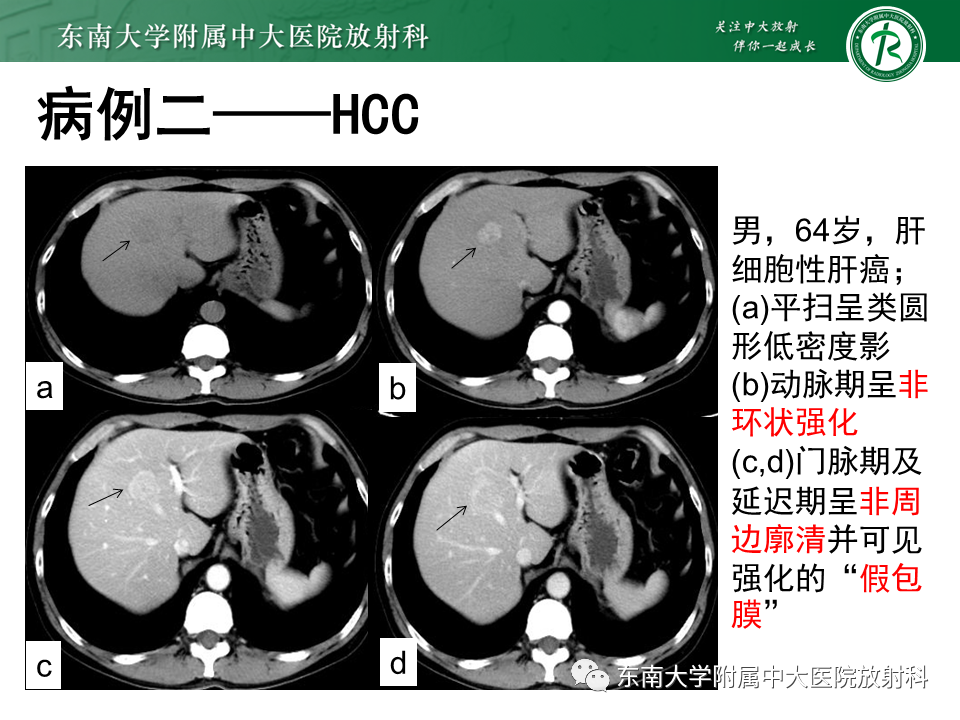 影像PPT - 【PPT】肝细胞癌（HCC）的影像-19