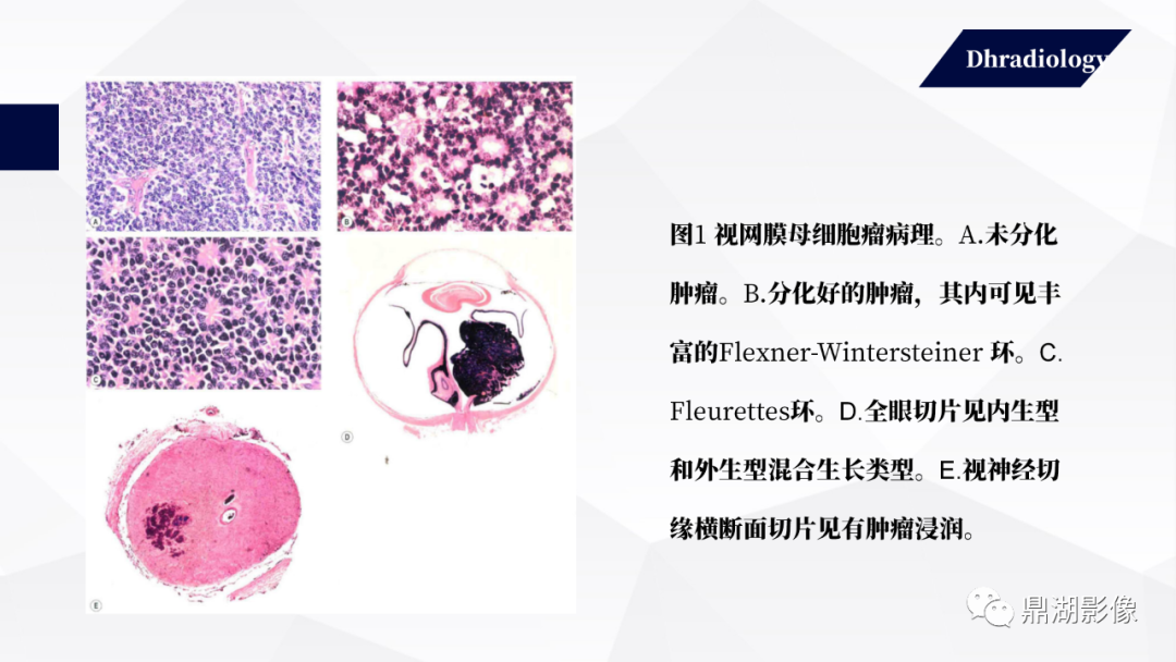 影像PPT - 【PPT】视网膜母细胞瘤影像诊断-4 影像PPT - 【PPT】视网膜母细胞瘤影像诊断-4