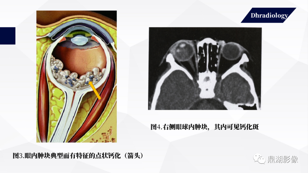 影像PPT - 【PPT】视网膜母细胞瘤影像诊断-16 影像PPT - 【PPT】视网膜母细胞瘤影像诊断-16
