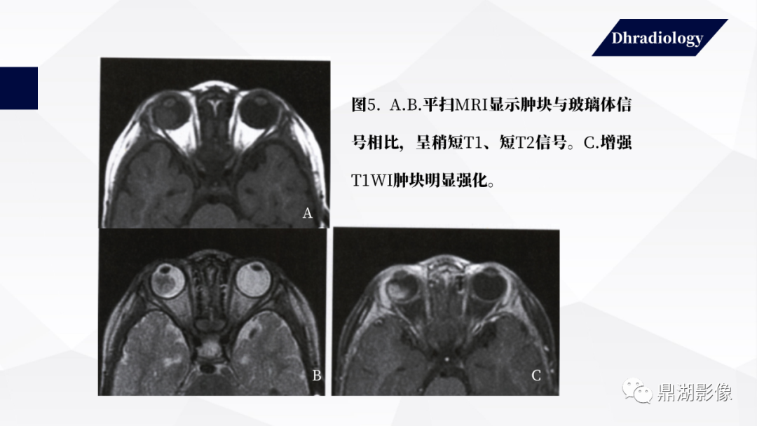 影像PPT - 【PPT】视网膜母细胞瘤影像诊断-19 影像PPT - 【PPT】视网膜母细胞瘤影像诊断-19