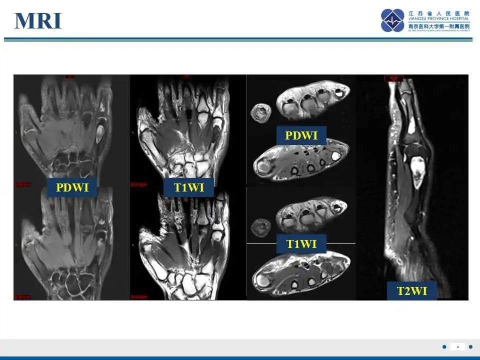 影像PPT - 【PPT】内生性软骨瘤-5