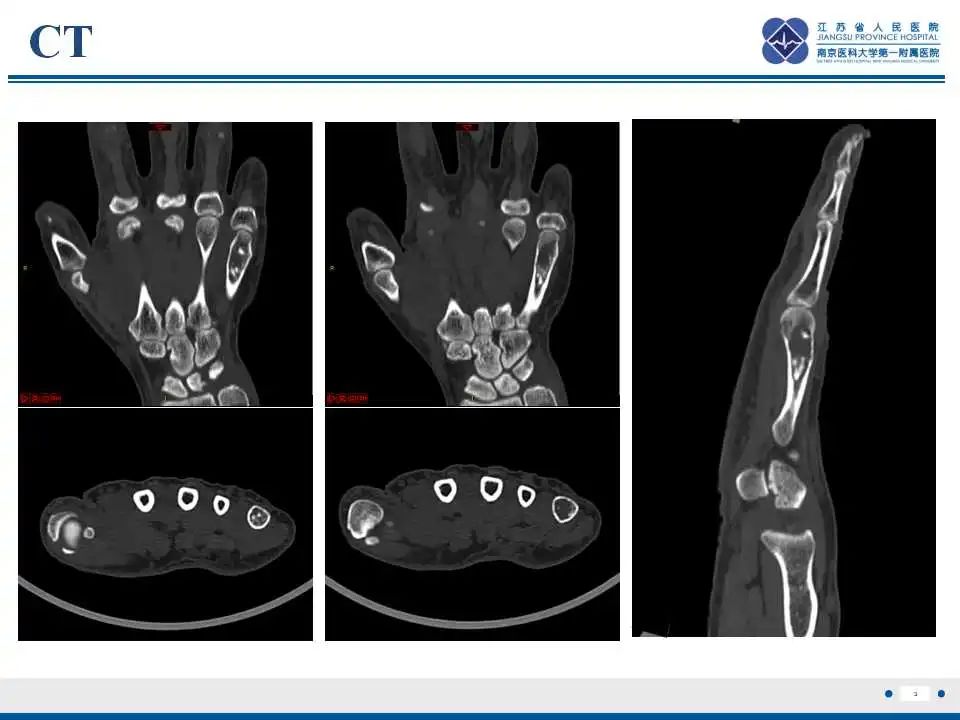 影像PPT - 【PPT】内生性软骨瘤-4
