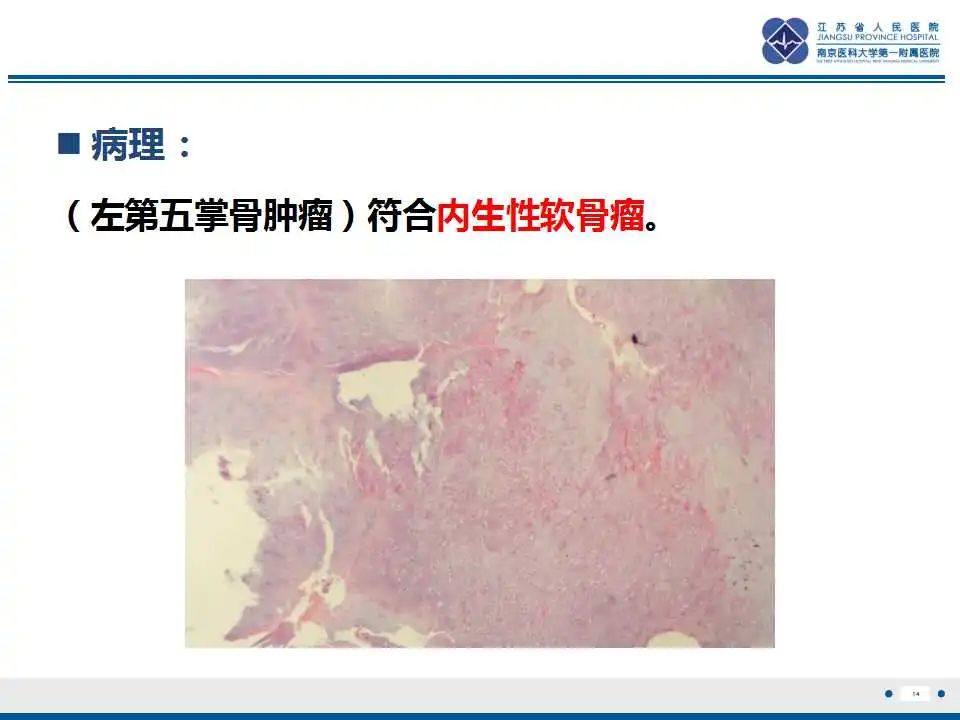 影像PPT - 【PPT】内生性软骨瘤-15