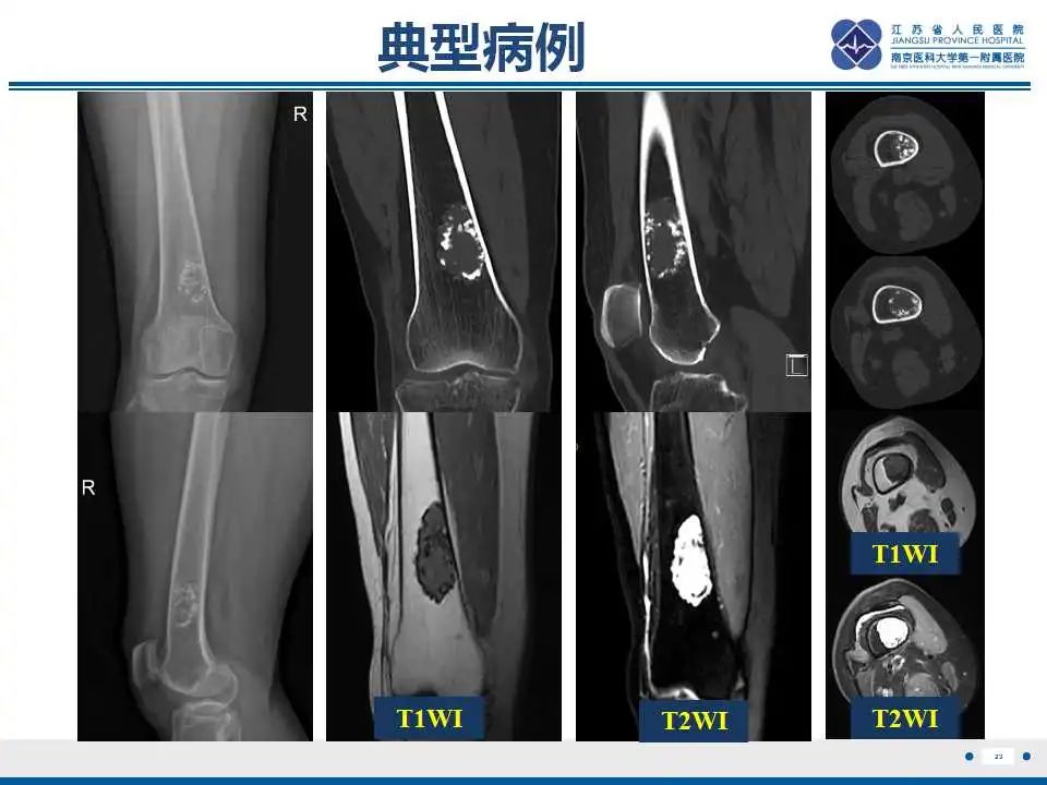 影像PPT - 【PPT】内生性软骨瘤-24
