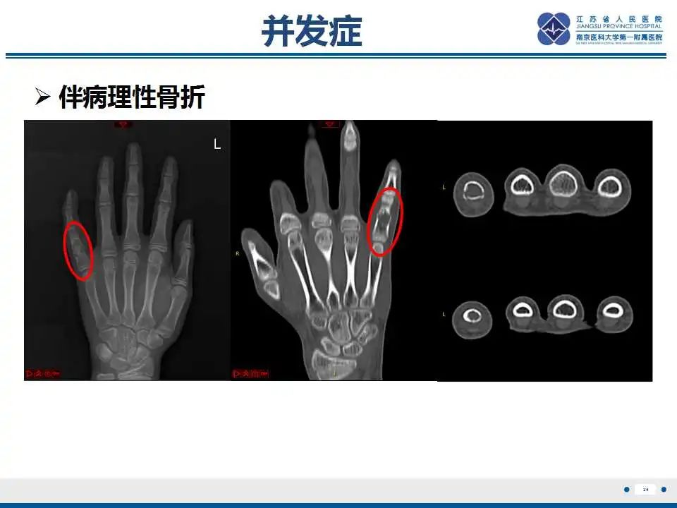 影像PPT - 【PPT】内生性软骨瘤-25