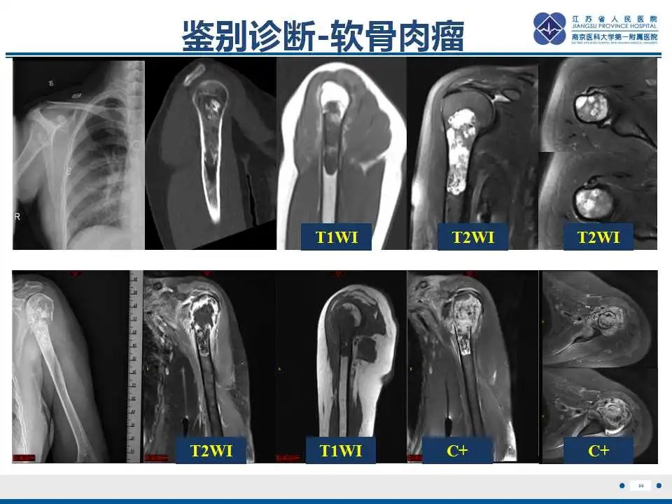 影像PPT - 【PPT】内生性软骨瘤-31