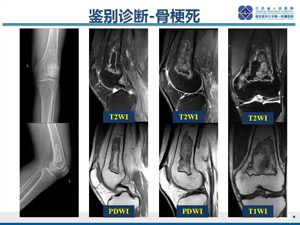 影像PPT - 【PPT】内生性软骨瘤-33