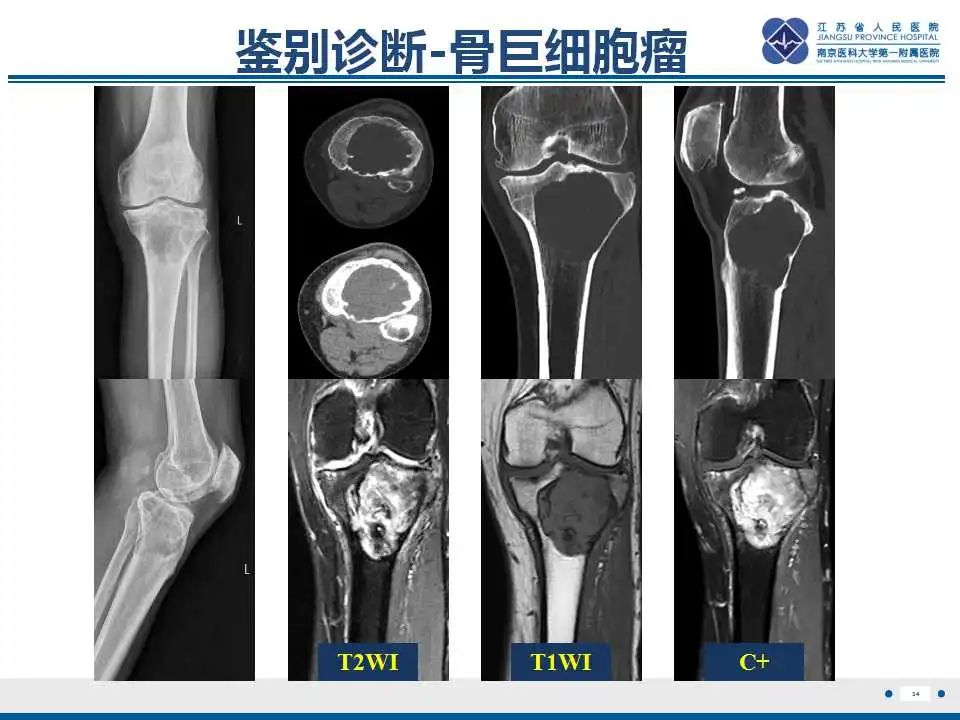 影像PPT - 【PPT】内生性软骨瘤-35