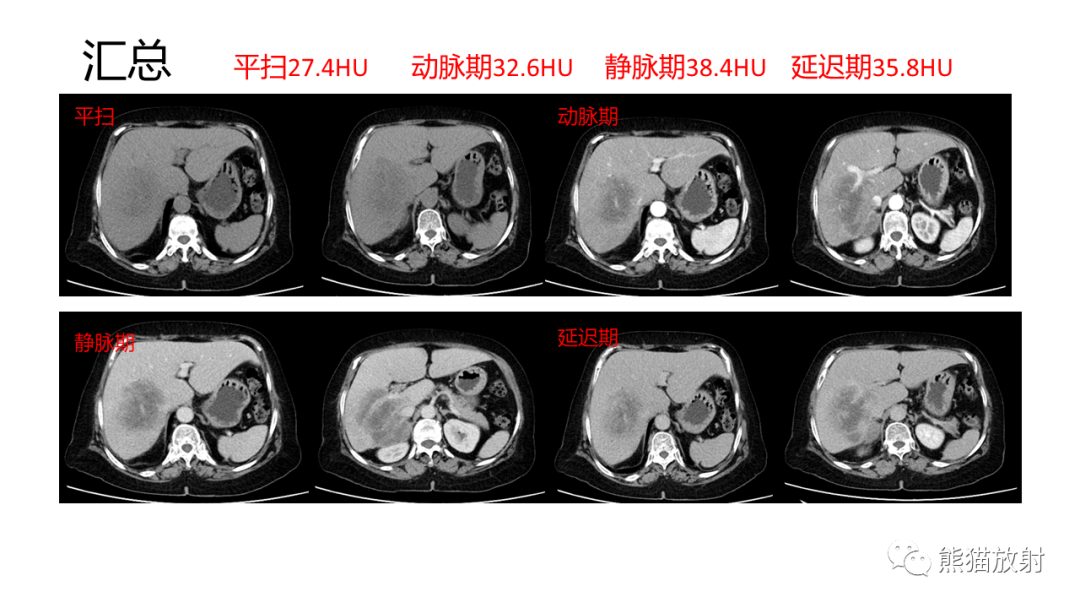 影像PPT - 【病例】肝内胆管细胞癌 VS 肝细胞性肝癌-9