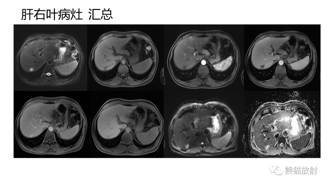 影像PPT - 【病例】肝内胆管细胞癌 VS 肝细胞性肝癌-22