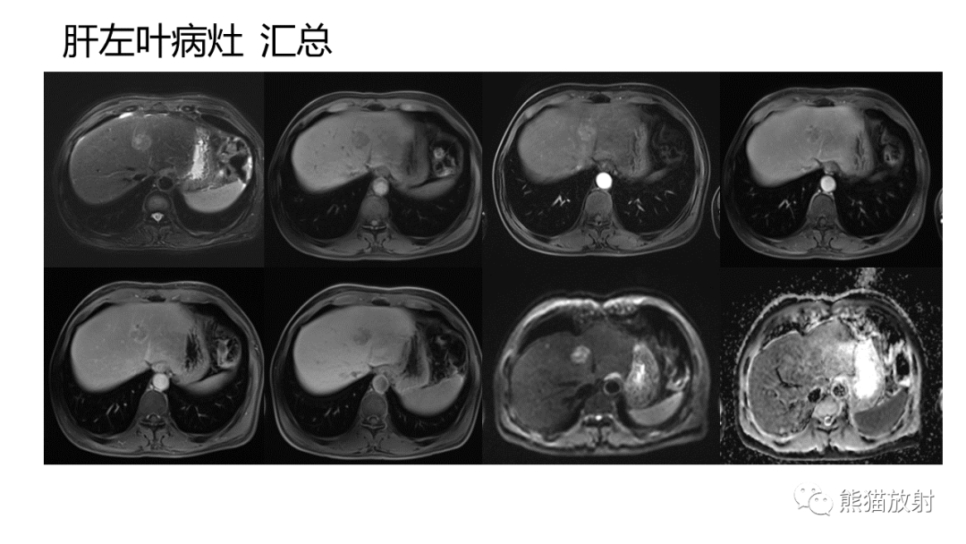 影像PPT - 【病例】肝内胆管细胞癌 VS 肝细胞性肝癌-21