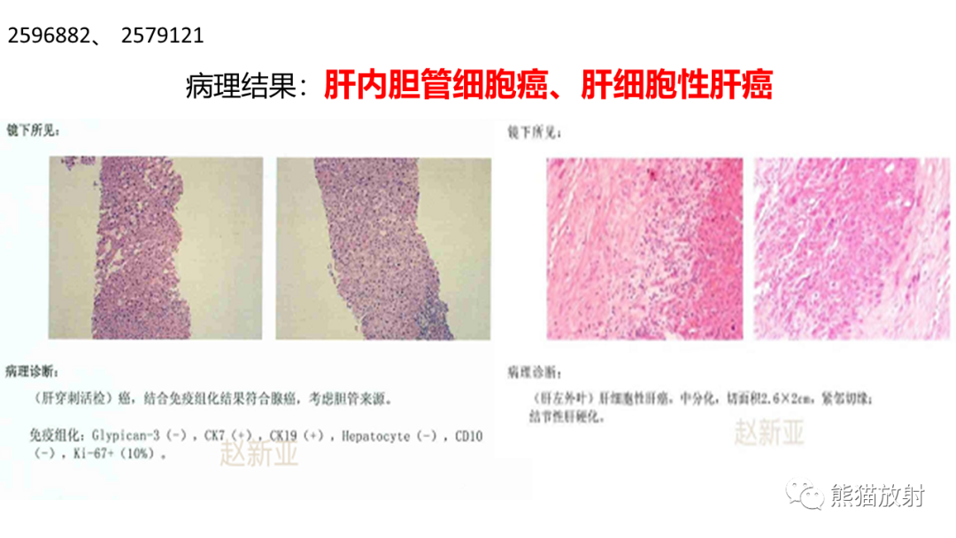 影像PPT - 【病例】肝内胆管细胞癌 VS 肝细胞性肝癌-24