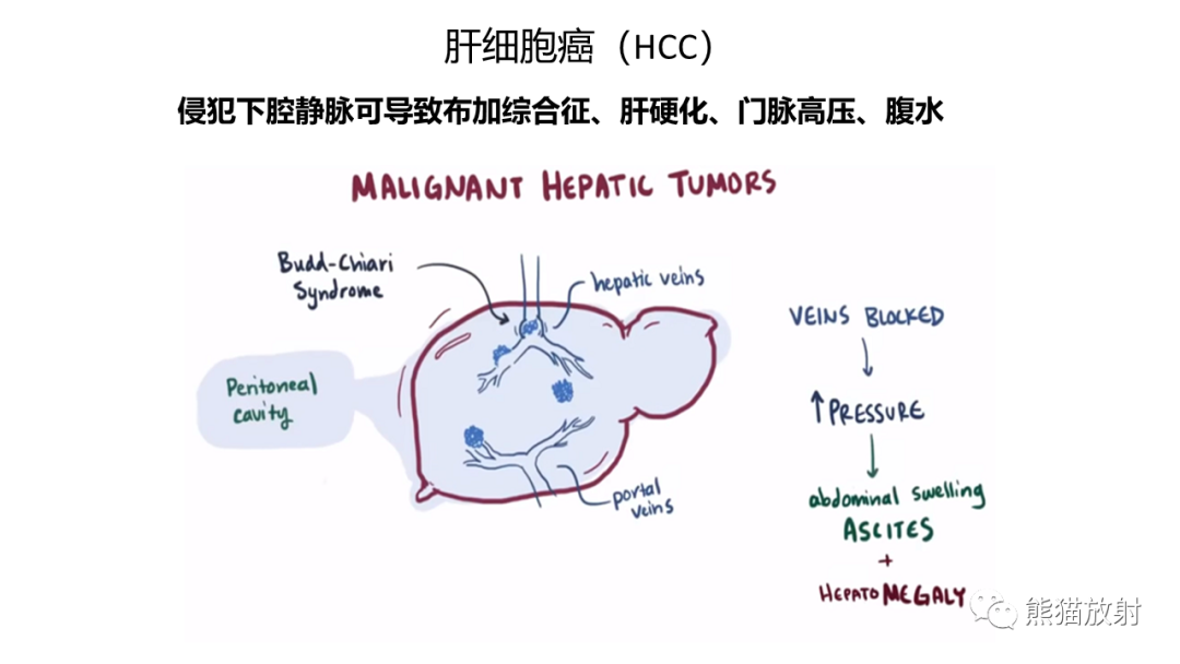 影像PPT - 【病例】肝内胆管细胞癌 VS 肝细胞性肝癌-34