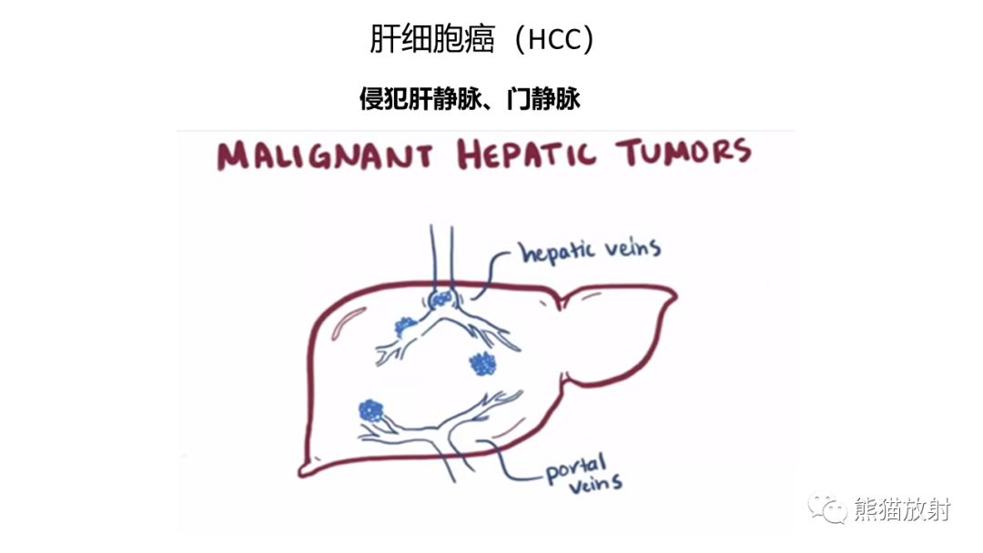 影像PPT - 【病例】肝内胆管细胞癌 VS 肝细胞性肝癌-33
