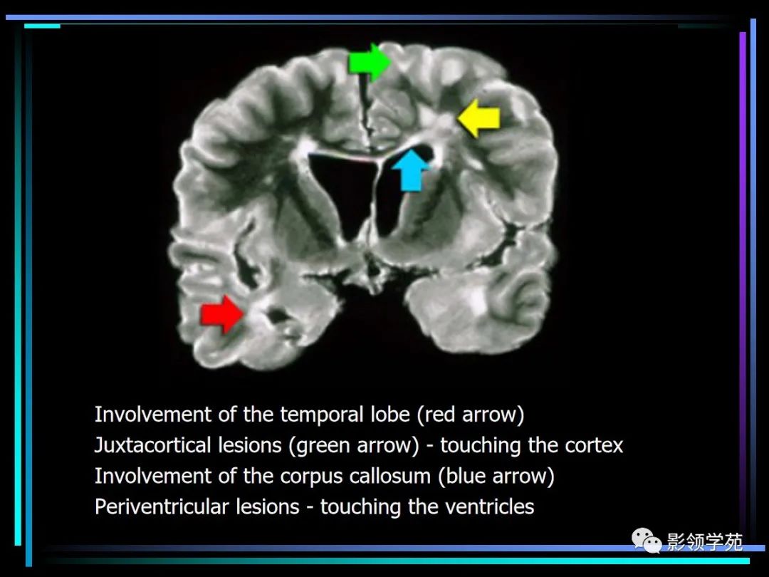 影像PPT - 【PPT】多发性硬化影像学诊断-8