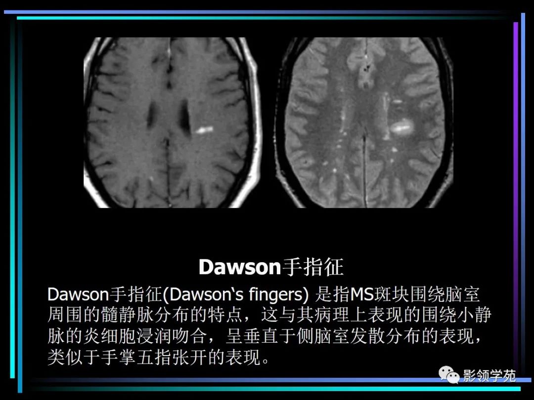影像PPT - 【PPT】多发性硬化影像学诊断-11