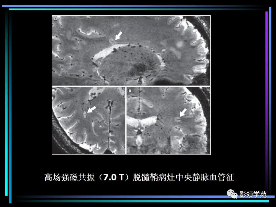 影像PPT - 【PPT】多发性硬化影像学诊断-13