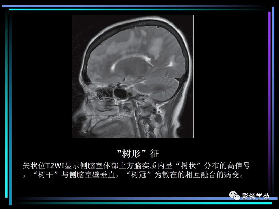 影像PPT - 【PPT】多发性硬化影像学诊断-17
