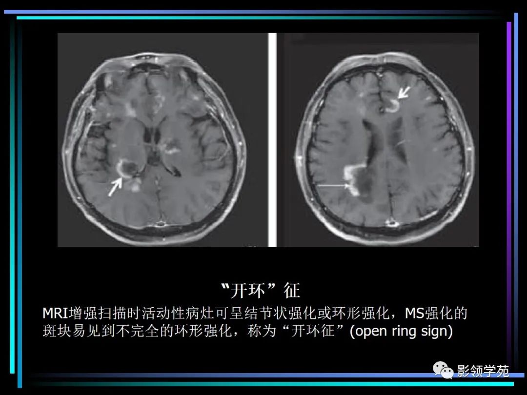影像PPT - 【PPT】多发性硬化影像学诊断-16