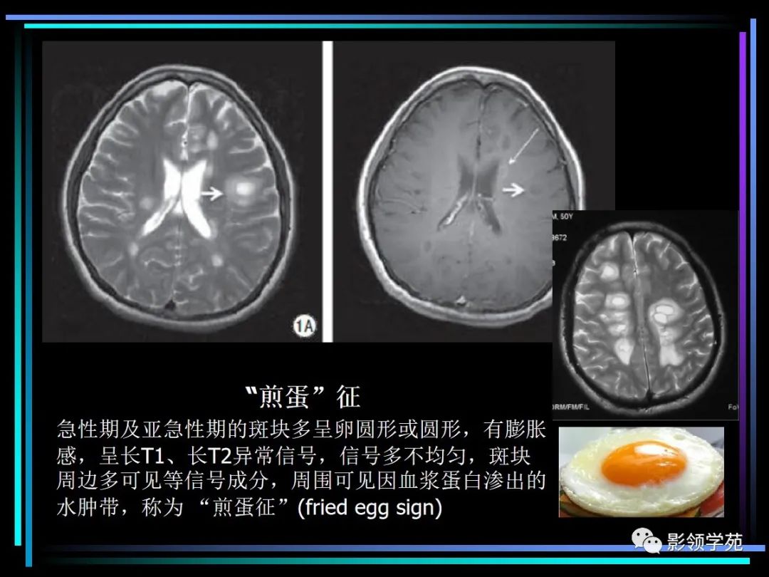 影像PPT - 【PPT】多发性硬化影像学诊断-14