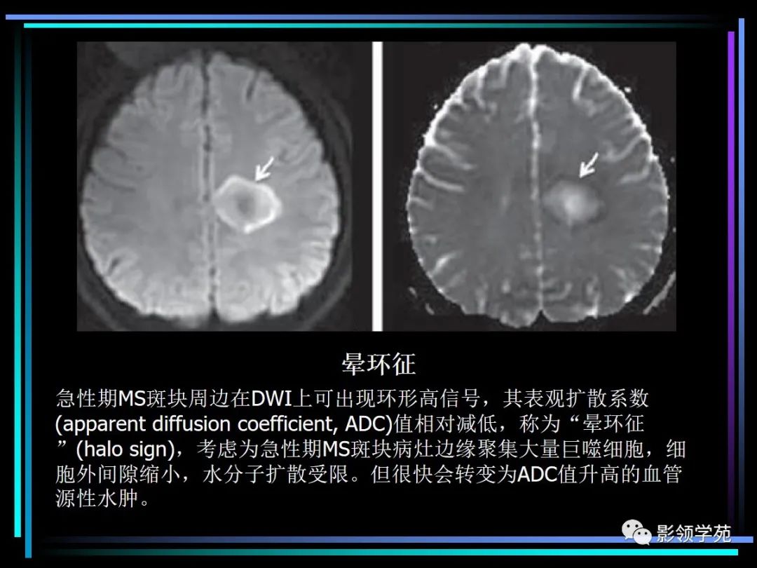 影像PPT - 【PPT】多发性硬化影像学诊断-15