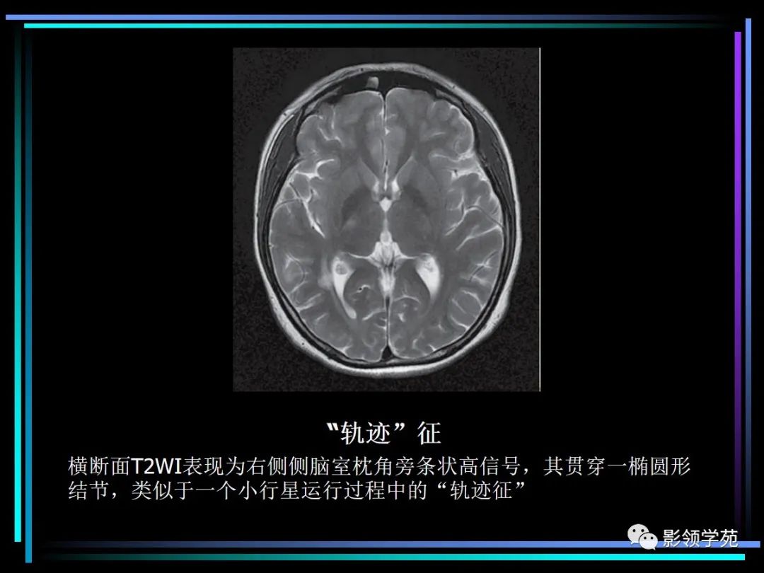 影像PPT - 【PPT】多发性硬化影像学诊断-18