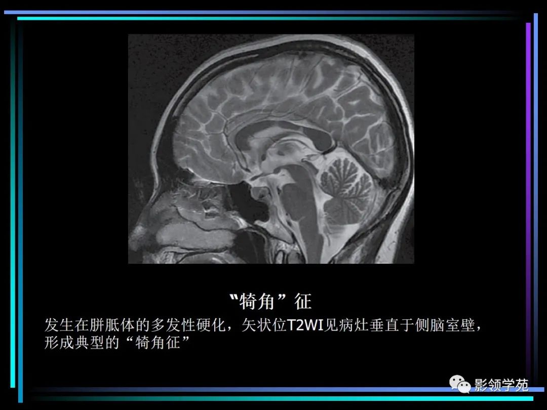 影像PPT - 【PPT】多发性硬化影像学诊断-19