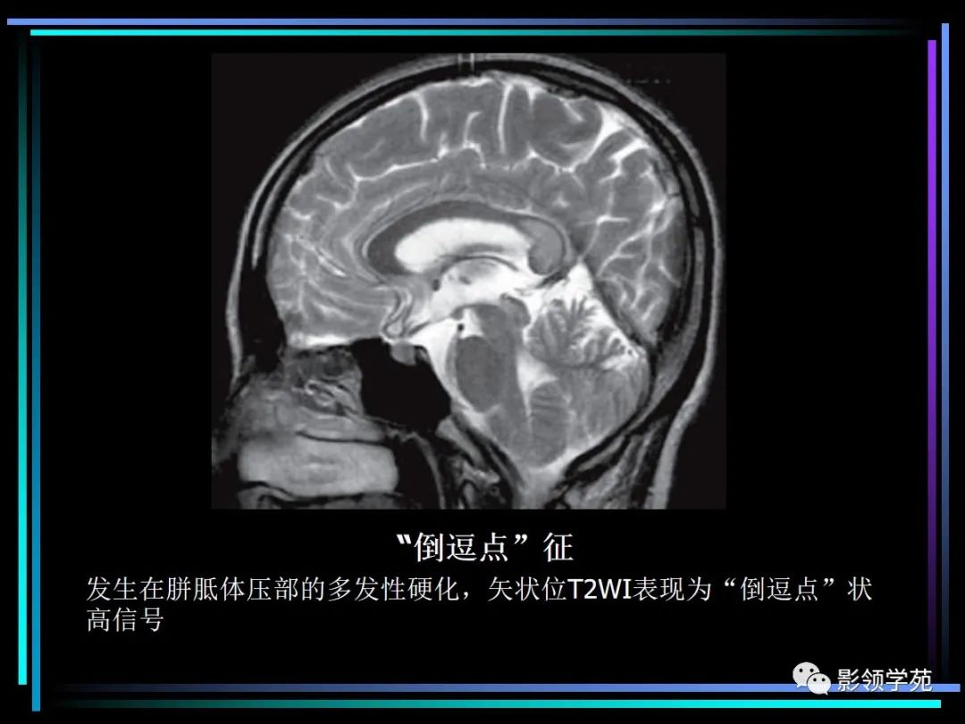 影像PPT - 【PPT】多发性硬化影像学诊断-20