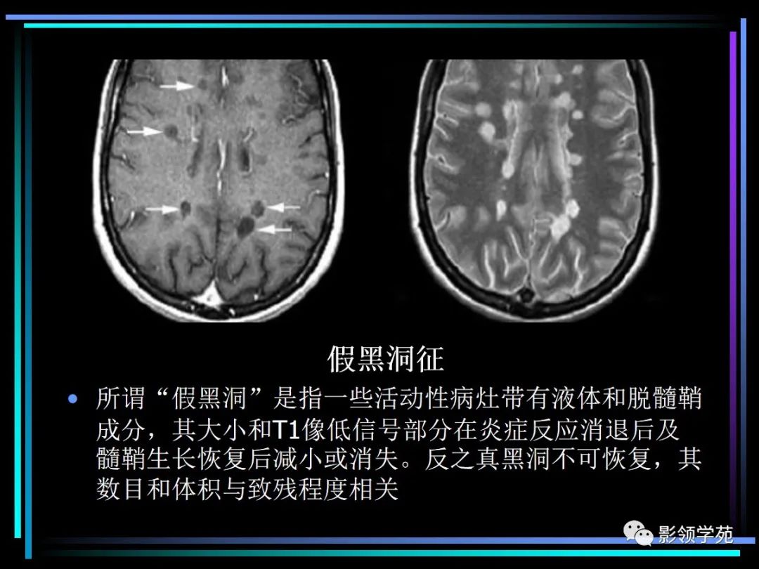 影像PPT - 【PPT】多发性硬化影像学诊断-22