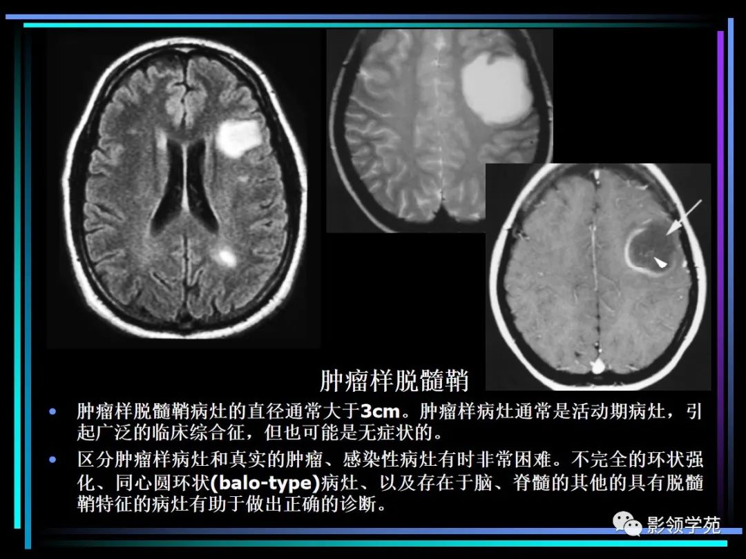 影像PPT - 【PPT】多发性硬化影像学诊断-23