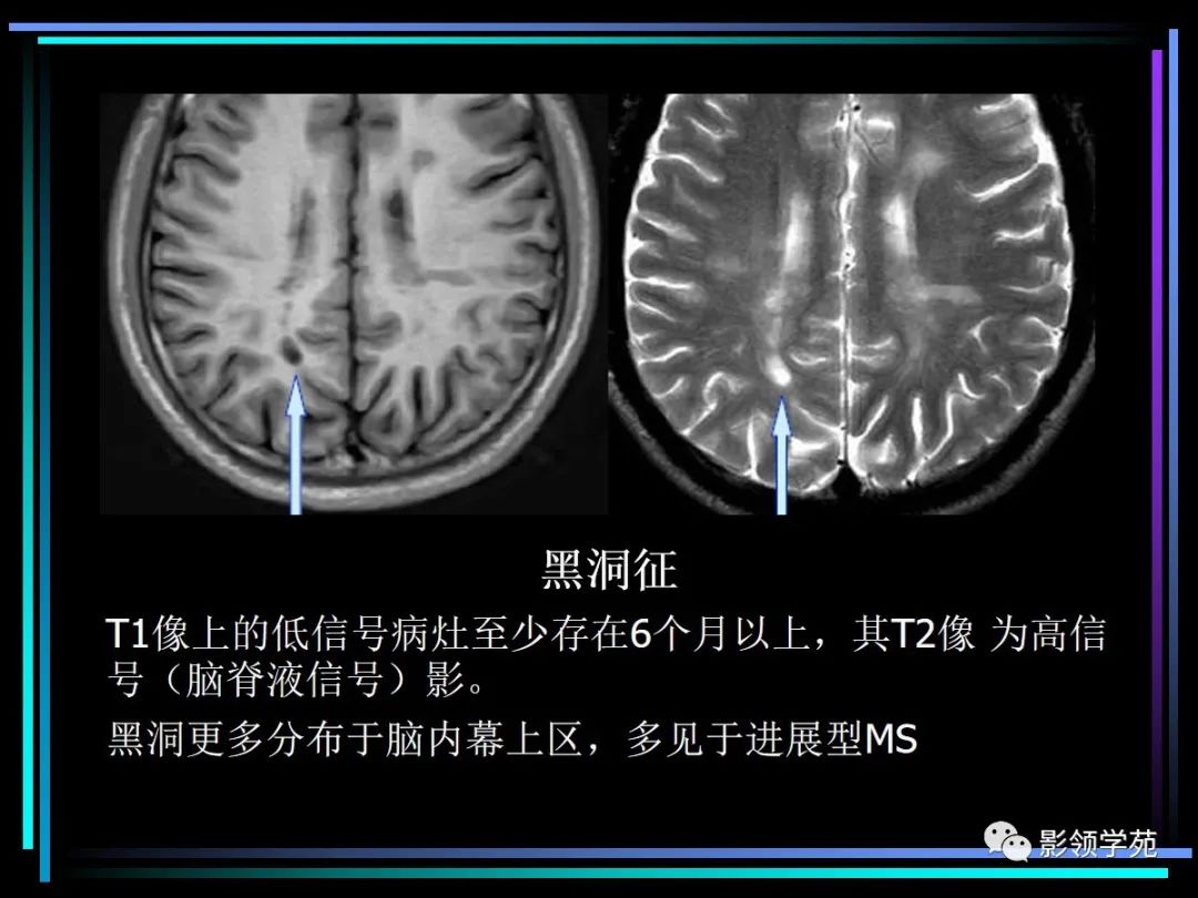 影像PPT - 【PPT】多发性硬化影像学诊断-21