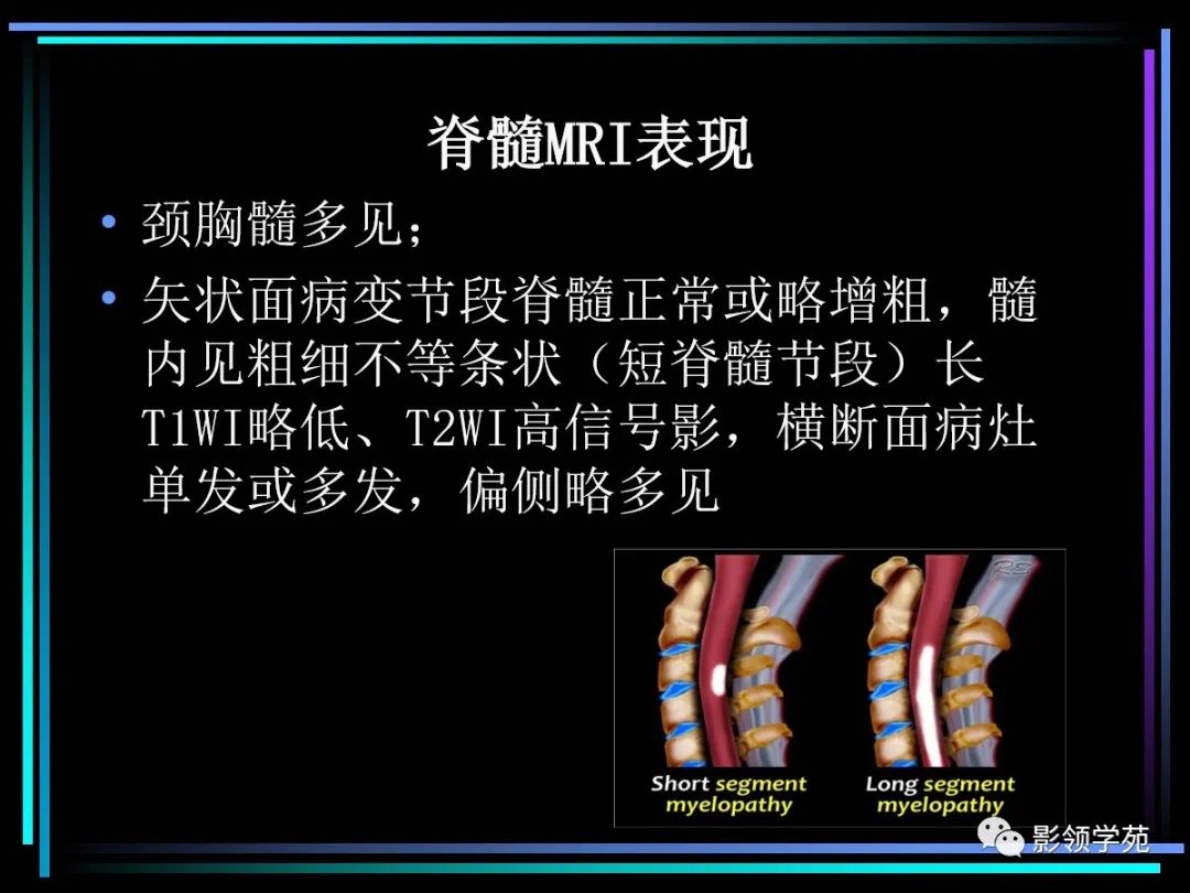 影像PPT - 【PPT】多发性硬化影像学诊断-24