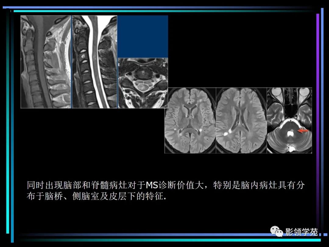 影像PPT - 【PPT】多发性硬化影像学诊断-27