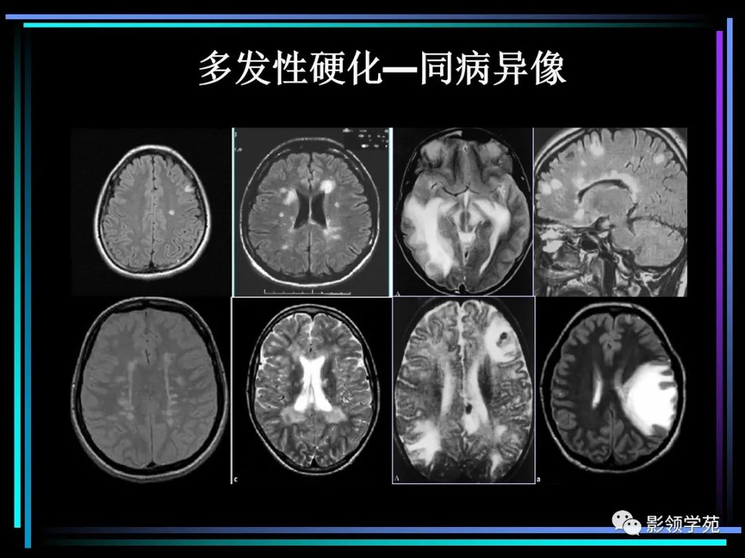 影像PPT - 【PPT】多发性硬化影像学诊断-30