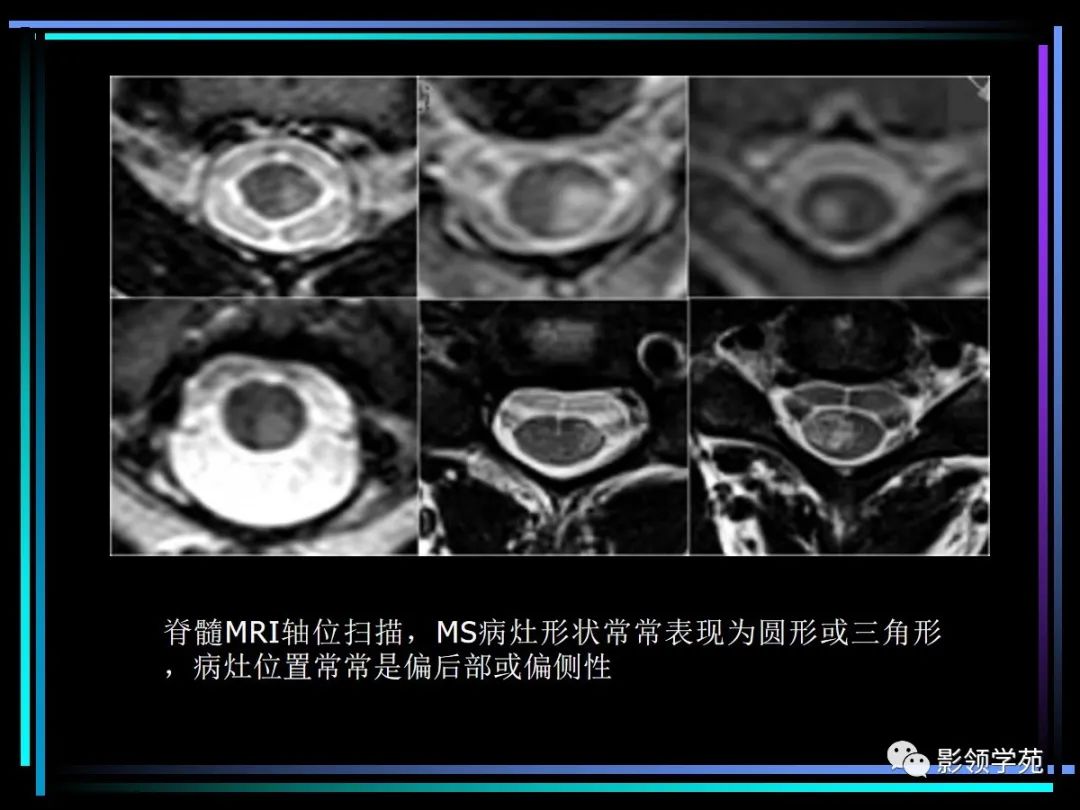 影像PPT - 【PPT】多发性硬化影像学诊断-26