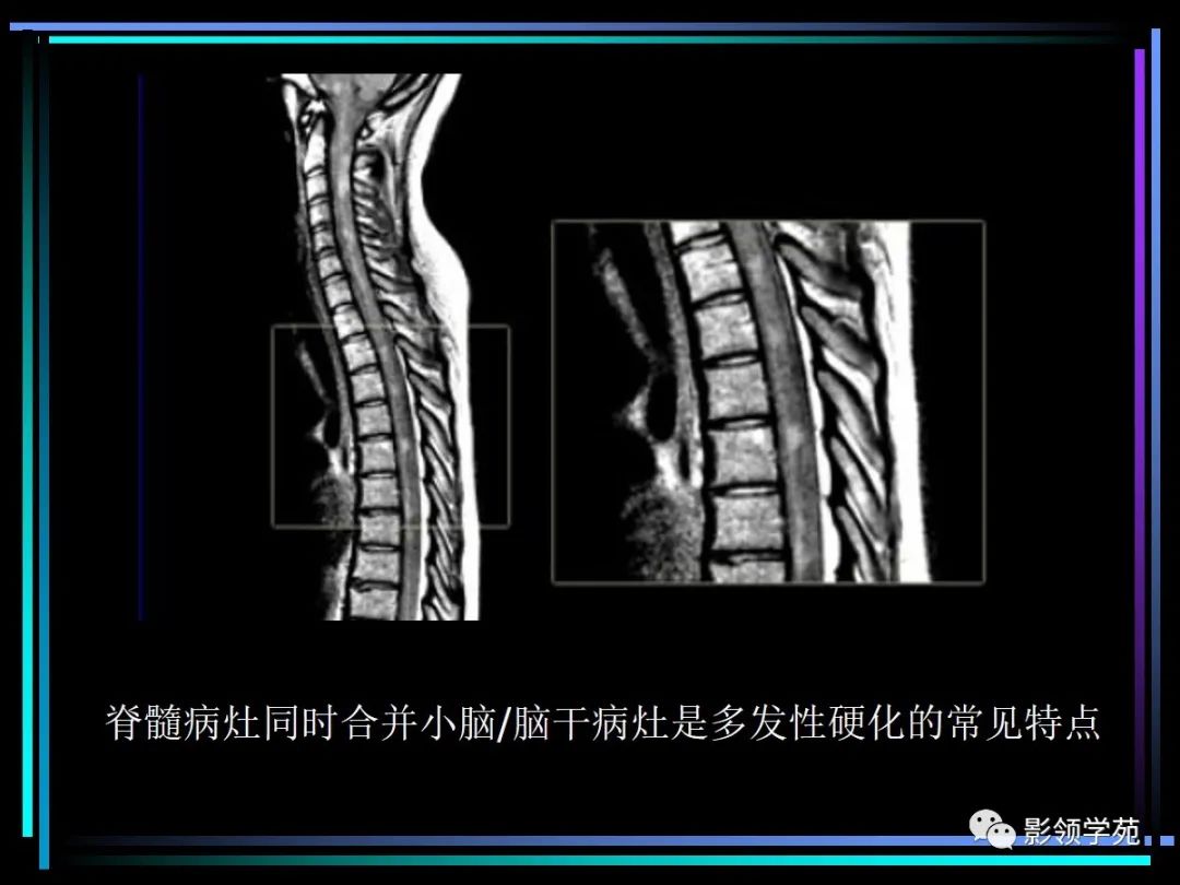 影像PPT - 【PPT】多发性硬化影像学诊断-25