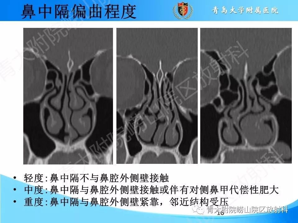 影像PPT - 【PPT】鼻中隔解剖及发育变异-16